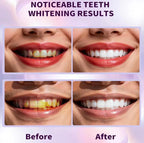 Purple Teeth Whitening Strips| Teeth Bleaching Color Corrector | Remove Stain In 30 Minutes