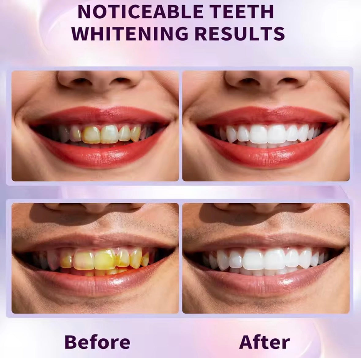 Purple Teeth Whitening Strips| Teeth Bleaching Color Corrector | Remove Stain In 30 Minutes